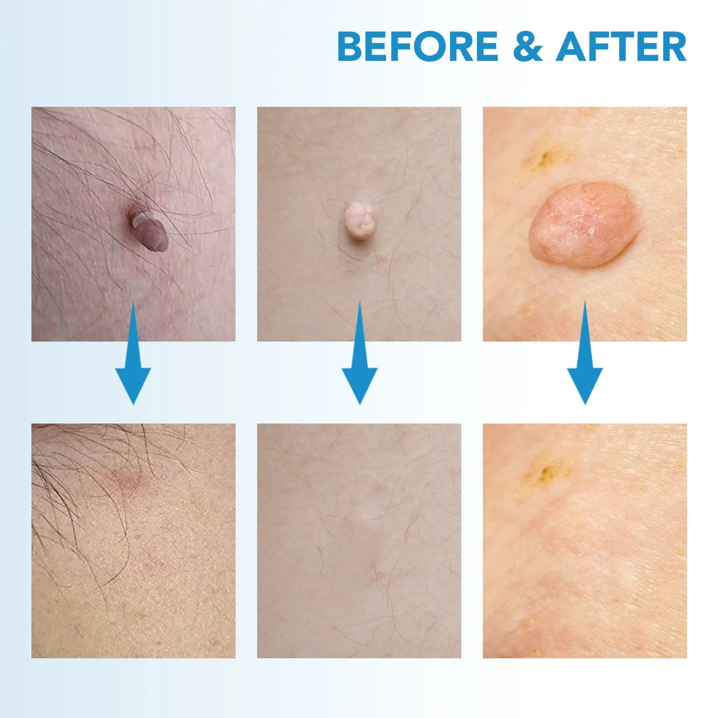 2-in-1 Auto Skin Tag Remover Kit for Moles, Warts & Stains
