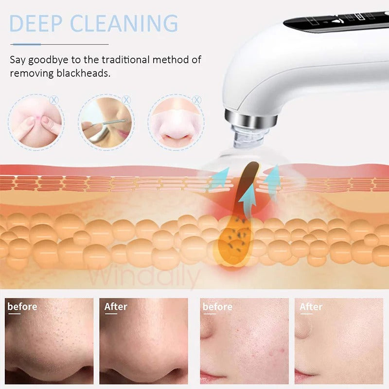 2025 Blackhead Remover & Pore Vacuum