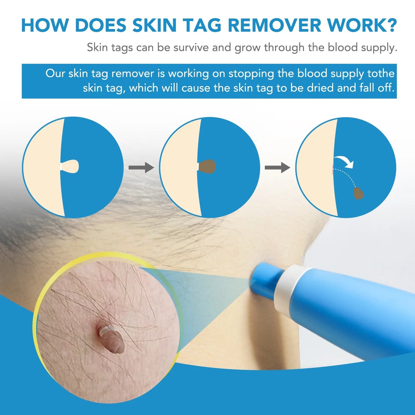 2-in-1 Auto Skin Tag Remover Kit for Moles, Warts & Stains