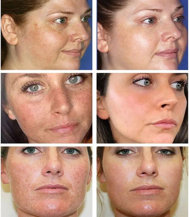 Dark Spot Remover Whitening Serum – Anti - Pigmentation & Brightening - RESTORALUX
