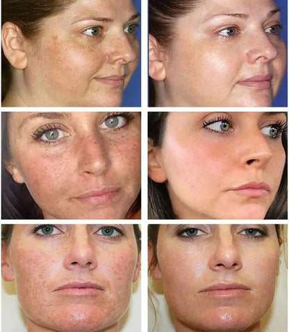 Dark Spot Remover Whitening Serum – Anti - Pigmentation & Brightening - RESTORALUX