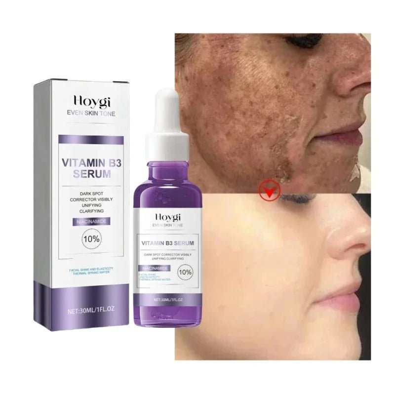 Dark Spot Remover Whitening Serum – Anti - Pigmentation & Brightening - RESTORALUX
