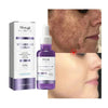 Dark Spot Remover Whitening Serum – Anti - Pigmentation & Brightening - RESTORALUX