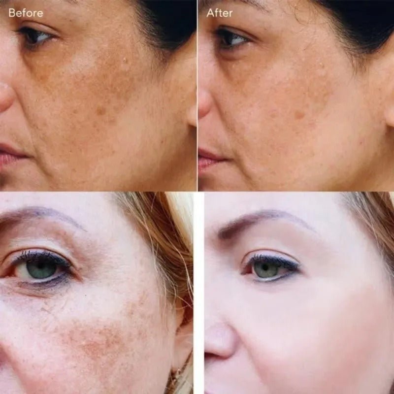 Dark Spot Remover Whitening Serum – Anti - Pigmentation & Brightening - RESTORALUX