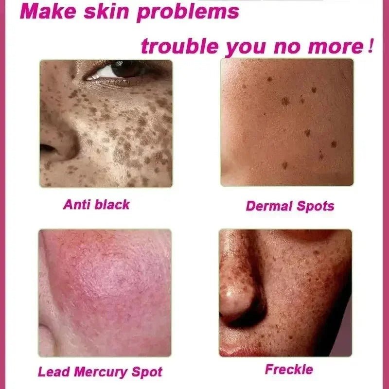 Dark Spot Remover Whitening Serum – Anti - Pigmentation & Brightening - RESTORALUX