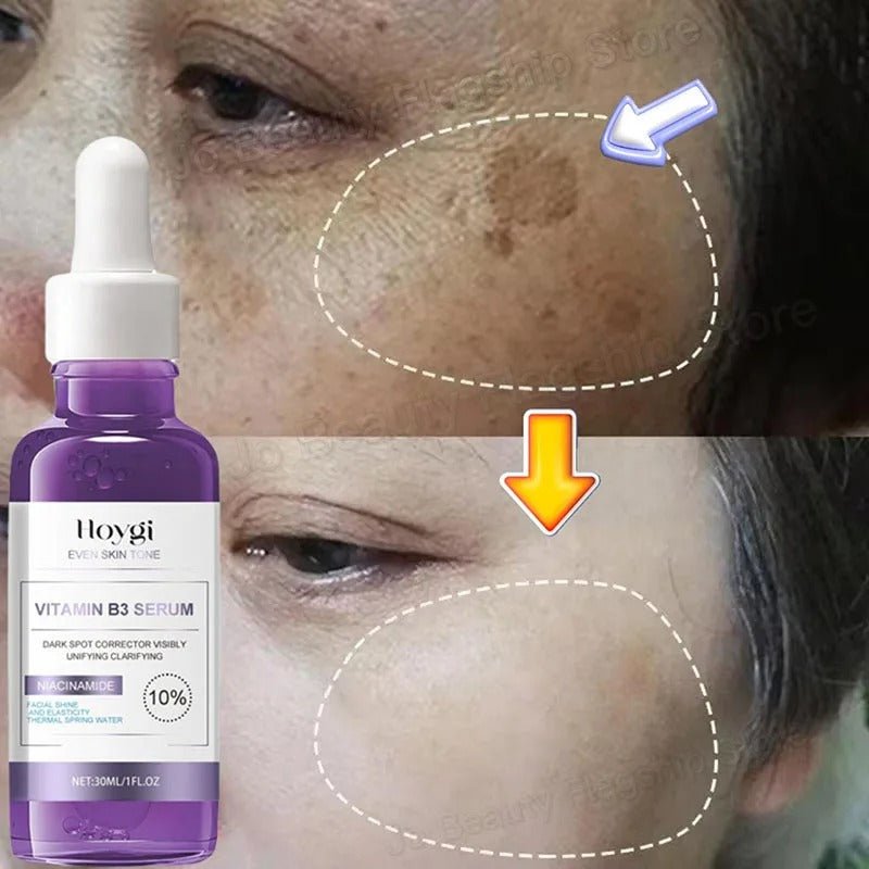 Dark Spot Remover Whitening Serum – Anti - Pigmentation & Brightening - RESTORALUX