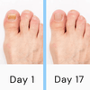 LumiNail Laser Nail Fungus Device – Low - Level Laser Therapy for Fingernail & Toenail Care - RESTORALUX