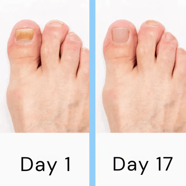 LumiNail Laser Nail Fungus Device – Low - Level Laser Therapy for Fingernail & Toenail Care - RESTORALUX