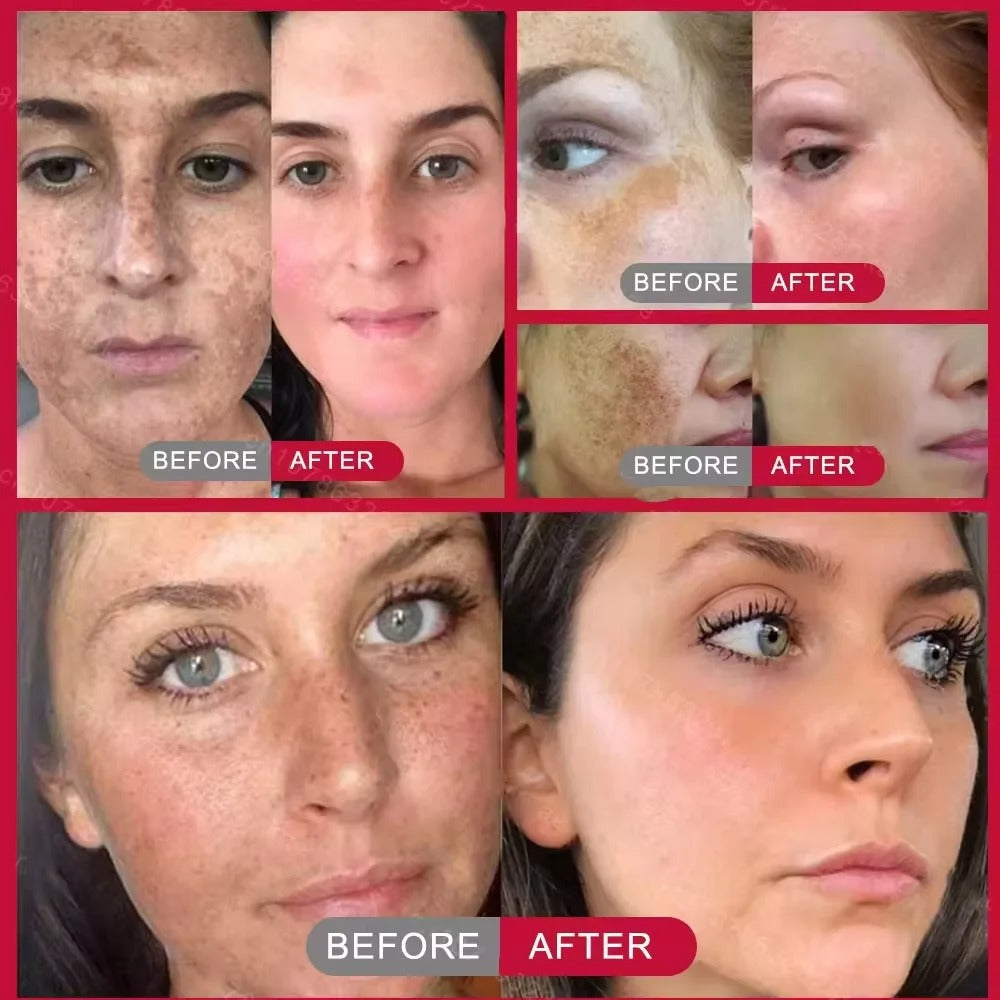 Whitening Freckles Face Cream
