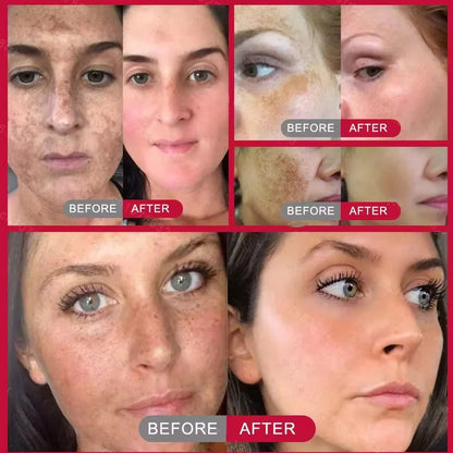 Whitening Freckles Face Cream