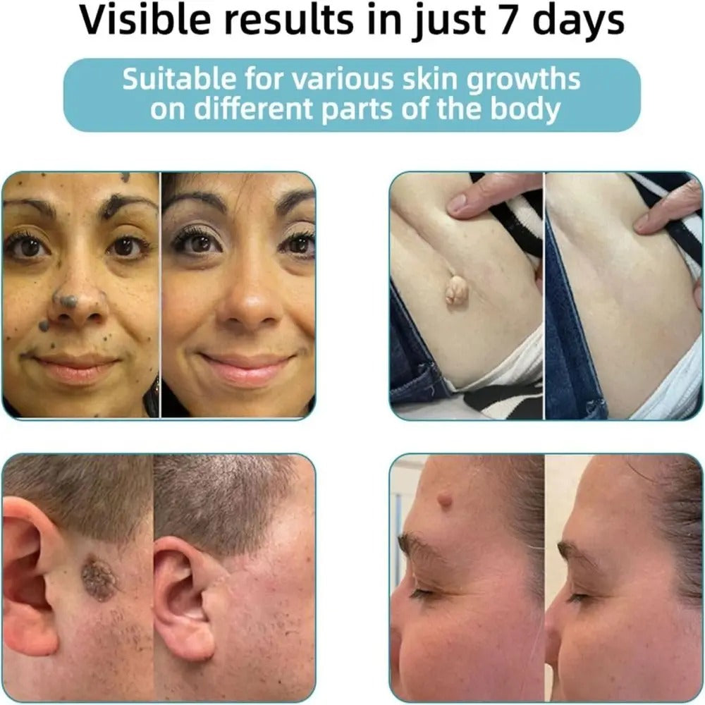Laser Skin Spot Removal Pen with Blue Light Therapy