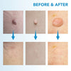 2-in-1 Auto Skin Tag Remover Kit for Moles, Warts & Stains