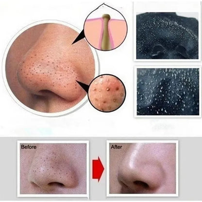 Bamboo Charcoal Blackhead Remover Mask – Pore Cleansing & Acne Care