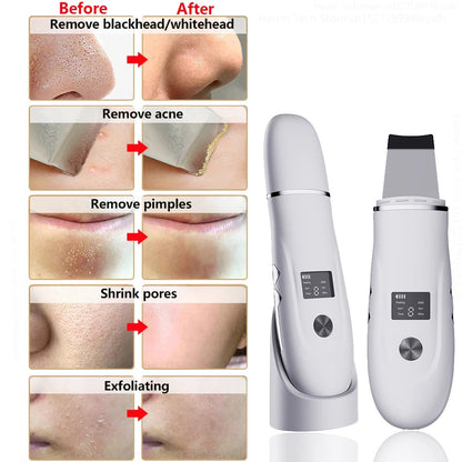 Ultrasonic Skin Scrubber Blackhead Remover Facial Pore Cleaner
