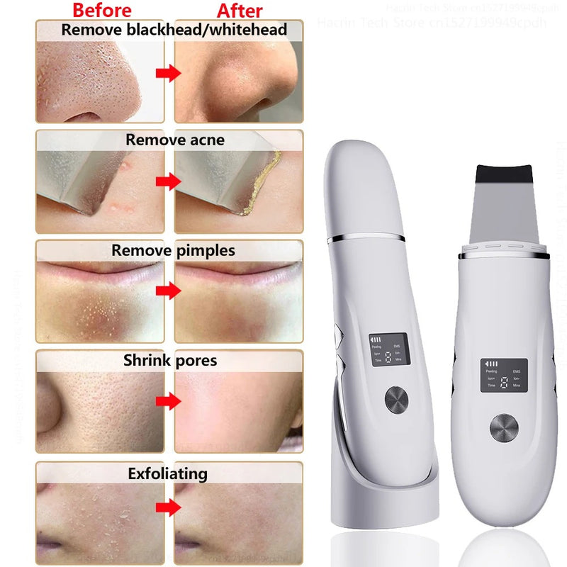 Ultrasonic Skin Scrubber Blackhead Remover Facial Pore Cleaner