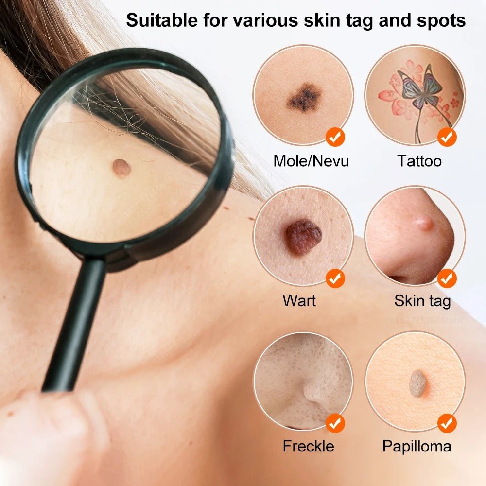 Plasma Pen Skin Tag Mole Wart Freckle Removal Device - RESTORALUX