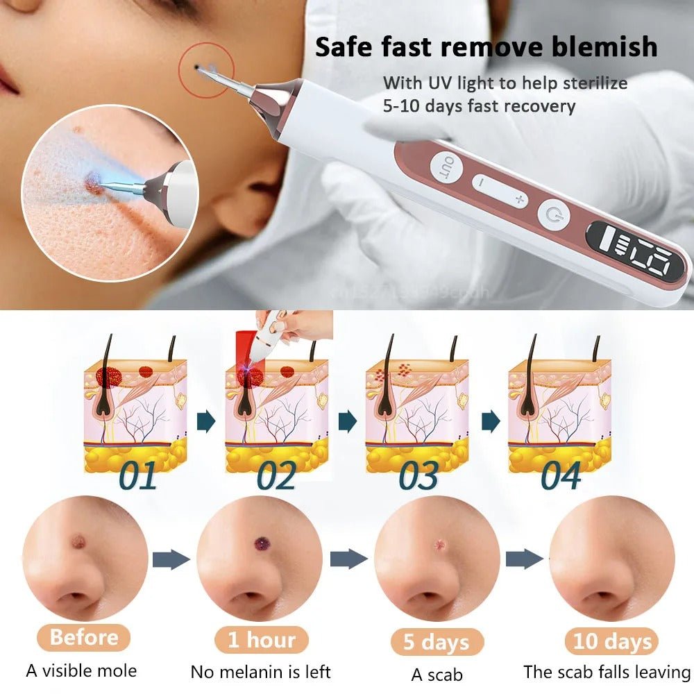 Plasma Pen Skin Tag Mole Wart Freckle Removal Device - RESTORALUX