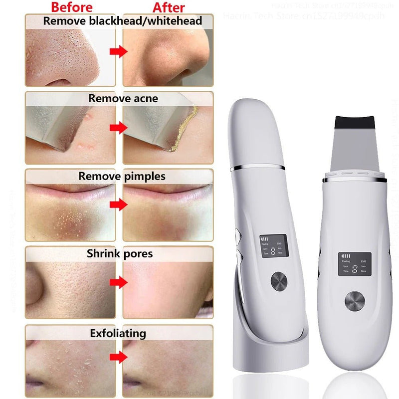 Ultrasonic Skin Scrubber Blackhead Remover Facial Pore Cleaner - RESTORALUX
